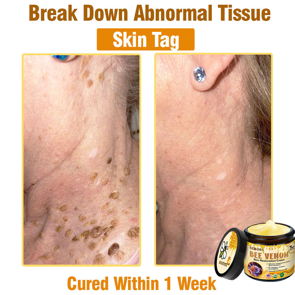 ✨FDA Approved: SEAGRIL® Bee Venom Skin Restoration Cream — 🔥Limited Time 50% OFF🔥